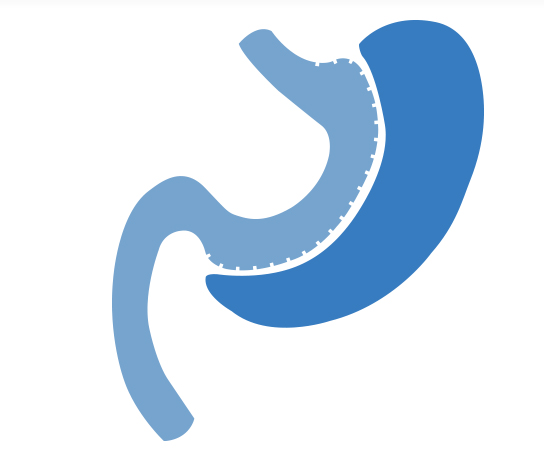 02-1_procedures-_page_DR-REYES--gastric-sleeve_03